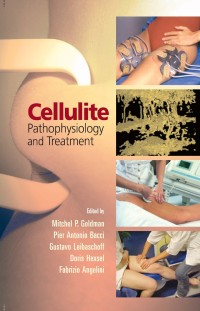 Image of Cellulite Pathophysiology And Treatment